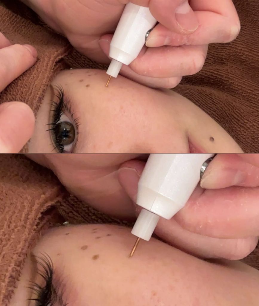 シミケアのダウンタイムレポ♡